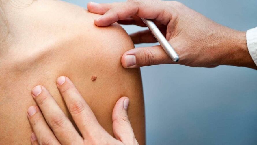 Dermatologe untersucht einen Patienten mit Papillom