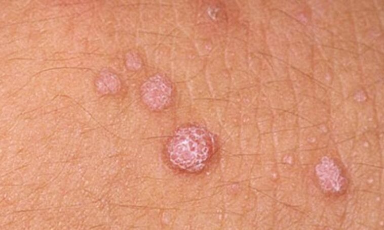 HPV verursacht das Auftreten von Hautflecken.