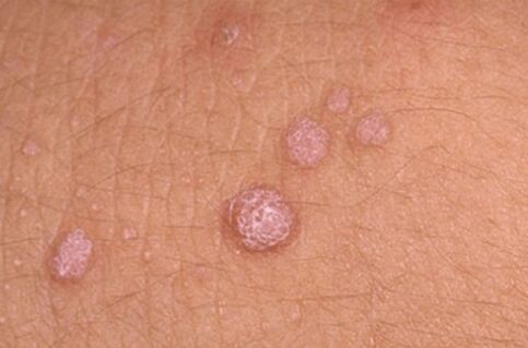 Symptome des humanen Papillomavirus