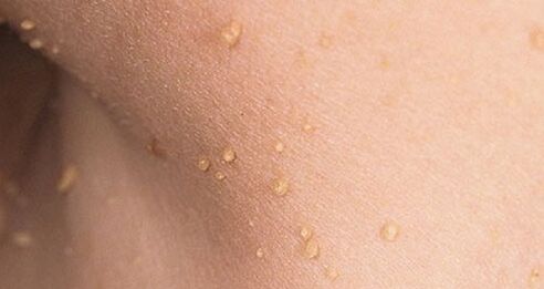 Wie manifestiert sich das humane Papillomavirus