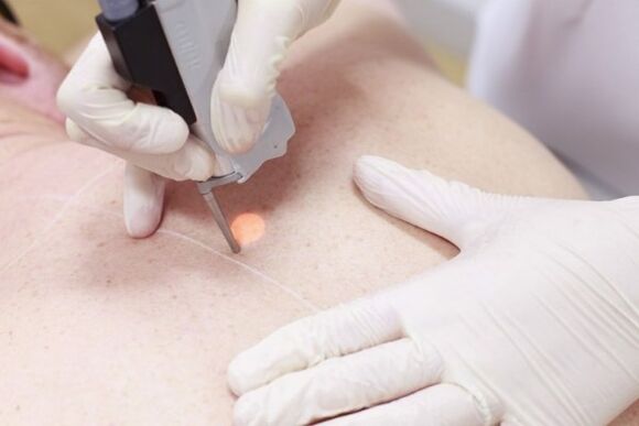 Eine beliebte Methode zur Entfernung von Papillomen mit einem Laser. 