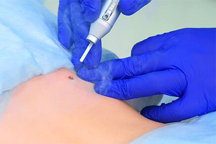 Laser Papilloma Entfernung