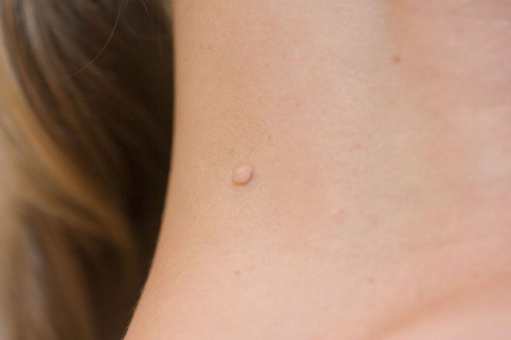 HPV-Symptome